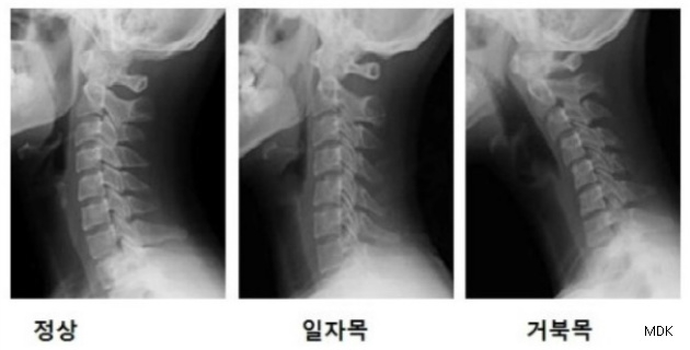 최근 컴퓨커와 스마트폰 사용으로 일자목증후군 환자 연령이 낮아지고 있다. 사진-Medical Device Korea
