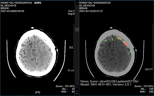 AI 뇌출혈 영상 의료 솔루션 ‘메디컬 인사이트 플러스 뇌출혈’ 데모(Demo) 화면...<사진= SK(주)C&C 제공>